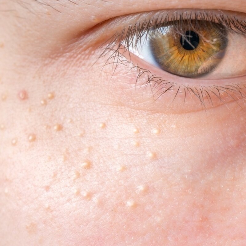 Dit helpt echt tegen gerstekorrels