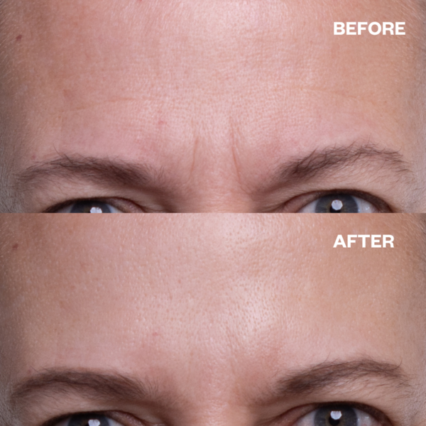 Wrinkle Schminkles Forehead Smooting Kit - anti rimpel pads voor het voorhoofd 1st