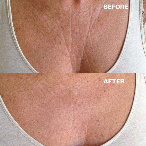 Wrinkle Schminkles Chest & Decolletage Smoothing Kit - anti rimpel pads voor je decollete  1 st
