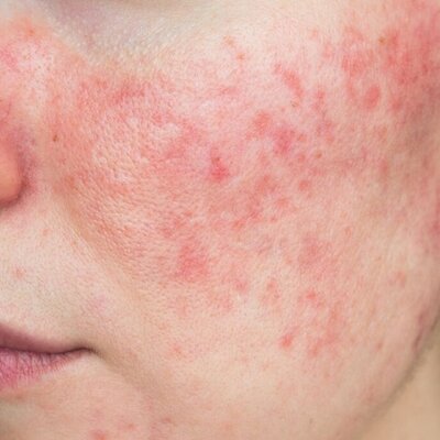 Alles wat je wilt weten over Rosacea