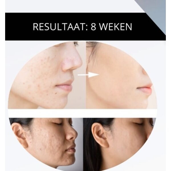 Ann Kathy Clear Skin Pillow Mist – Spray zur Linderung von Akne