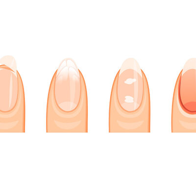 Nagel problemen? Trind Perfect Systeem helpt gegarandeerd!!