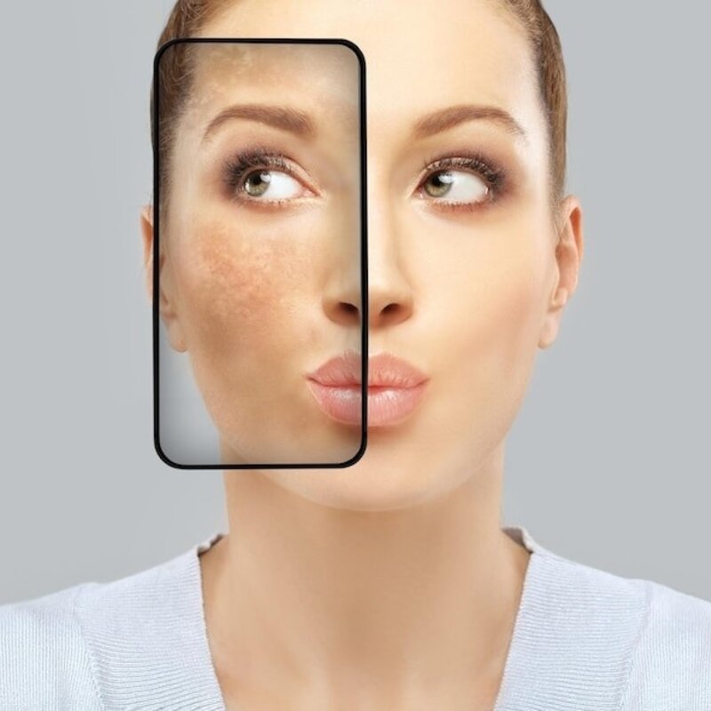 Wat te doen bij pigmentvlekken?