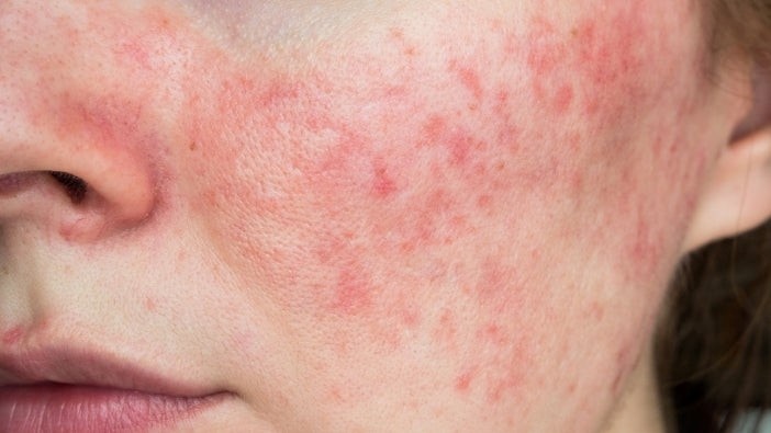 Rosacea