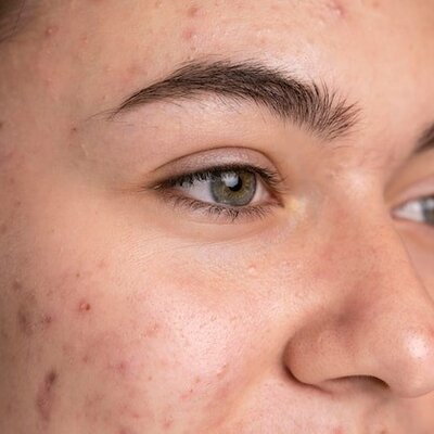 Alles over Acne, hoe voorkomen, oorzaken en behandeling