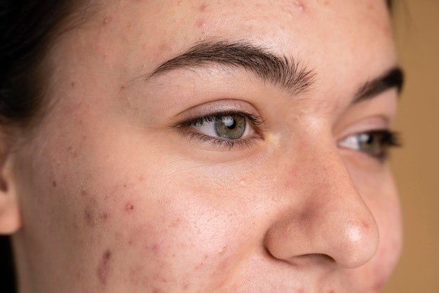 Alles over Acne, hoe voorkomen, oorzaken en behandeling