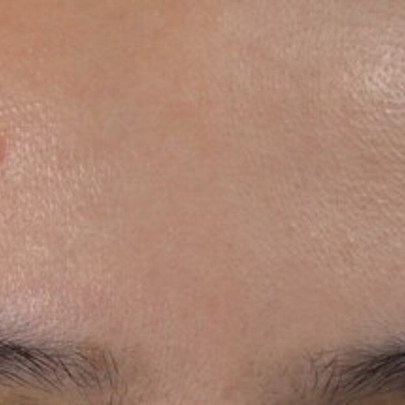 Beste tips voor acne verzorgen bij een vette huid