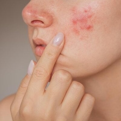 Verzorgingstips van Rosacea bij een Vette huid