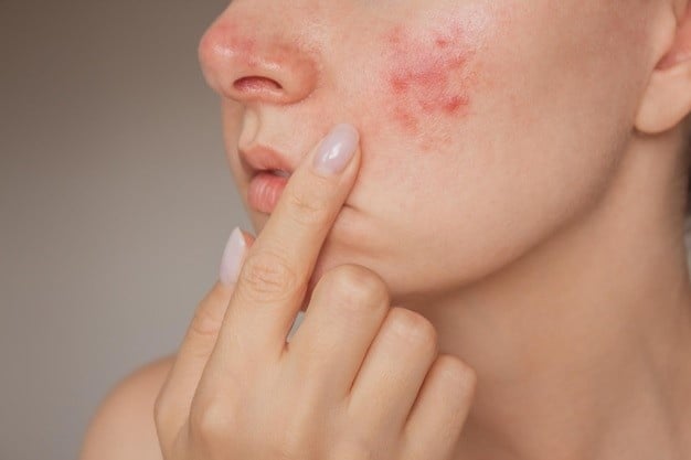 Verzorgingstips van Rosacea bij een Vette huid