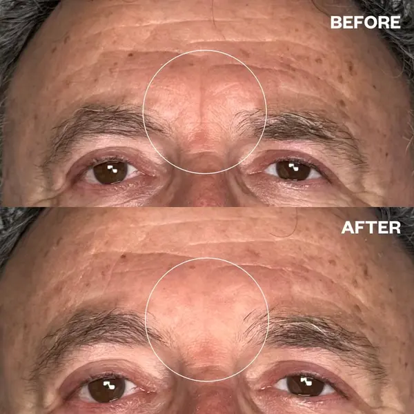 Wrinkle Schminkles Men Forehead 2st