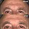 Wrinkle Schminkles For Men Forehead 2st