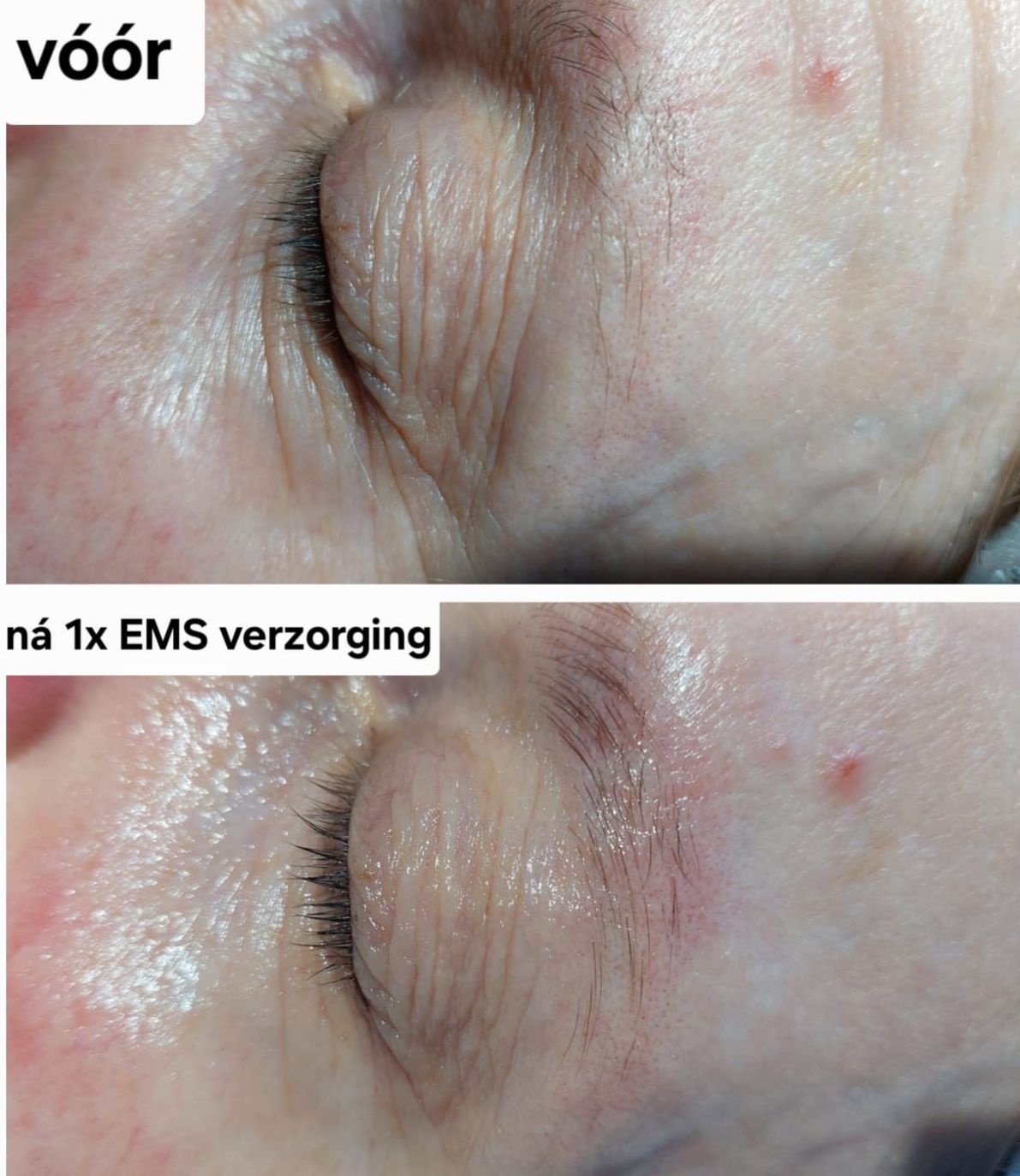 Resultaat Decaar EMS oogverzorging