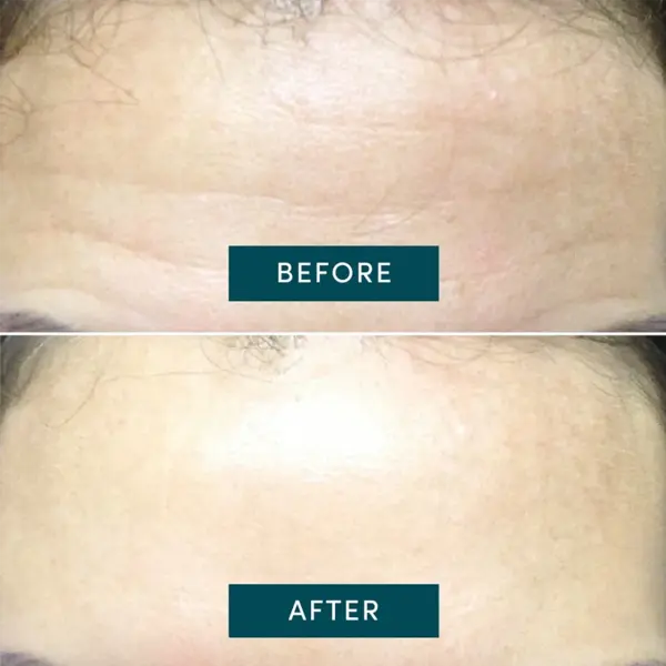 Apricot Beauty Forehead Pad Hexapeptide Technology 30st