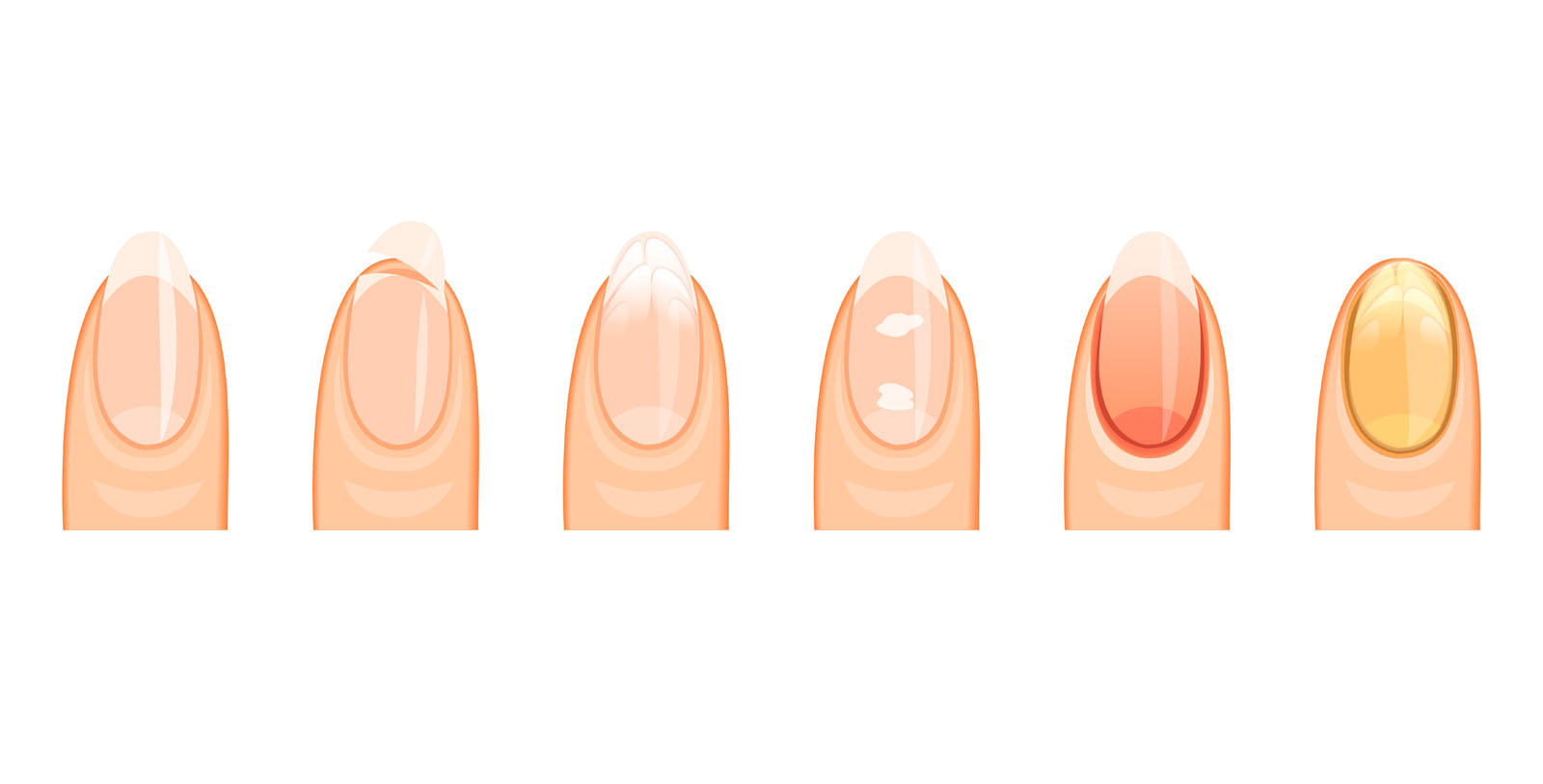 Nagelprobleme?  Wir beraten Sie kostenlos