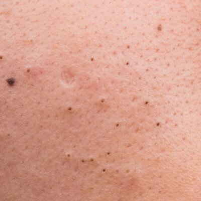Mitesser – so beugst du ihnen vor und entfernst sie!