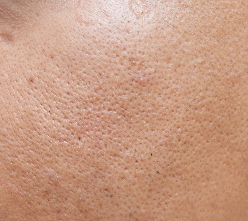 Was hilft denn wirklich gegen grobe Poren?