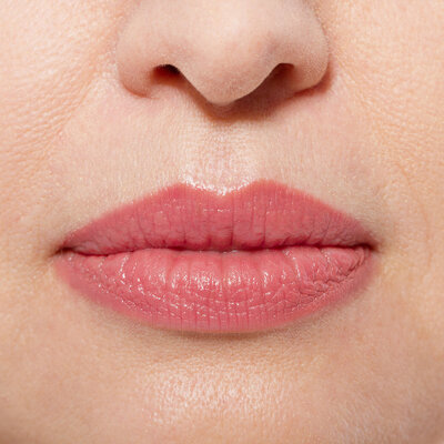 Immer mehr Hautkrebs an den Lippen – so beugen Sie ihm vor