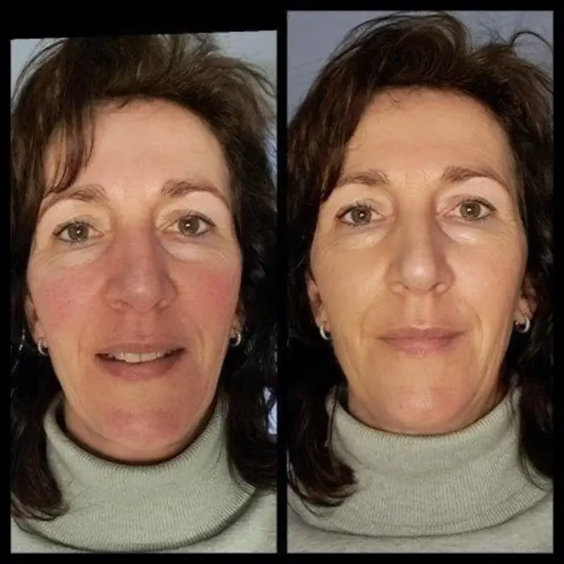 Make-up-Tipps bei Couperose und Rosazea