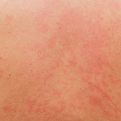 Hilfe! Nach dem Duschen ist meine Haut immer gerötet.