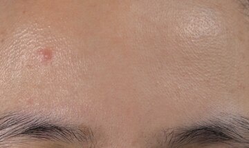 Die besten Tipps zur Akne-Pflege bei fettiger Haut