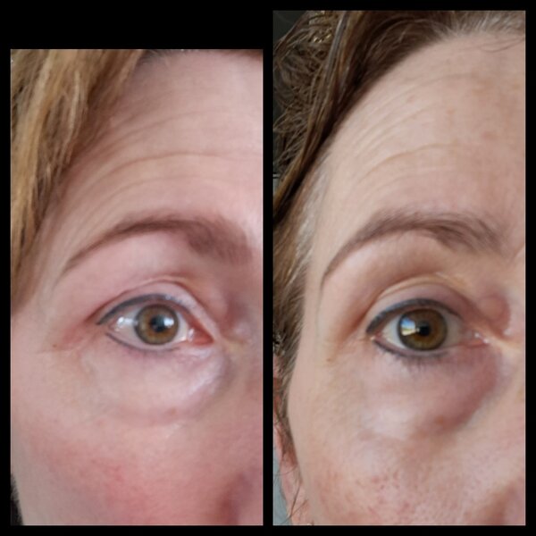 Decaar  Pulselift Eye Duo -  revolutionaire EMS oogverzorgingsapparaat - tegen huidverslapping en rimpels  rondom de ogen