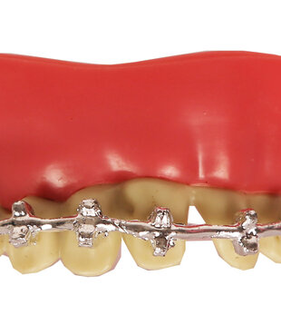 Tanden Beugel Thermoplastic