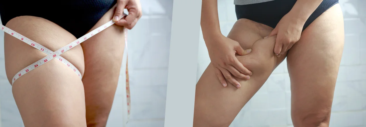 Dikke benen: oorzaken, tips & oefeningen voor slankere benen Dikke benen: oorzaken, tips & oefeningen voor slankere benen