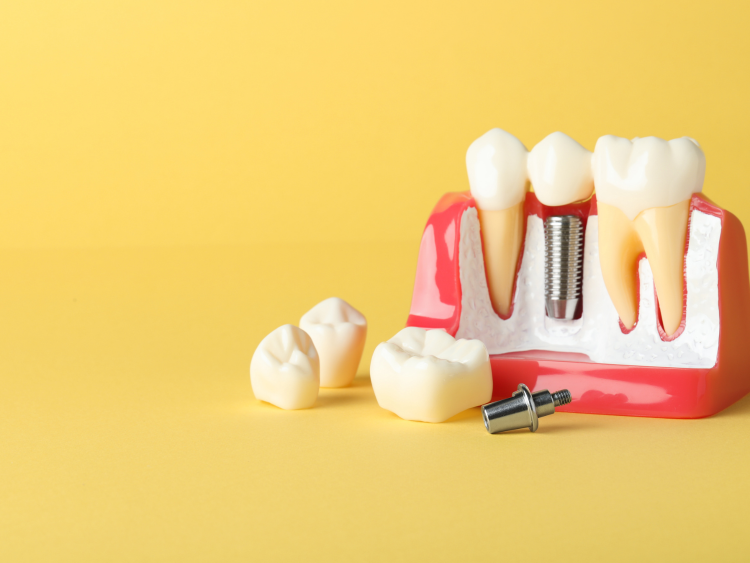 Wat zijn implantaten en hoe moet je ze onderhouden?