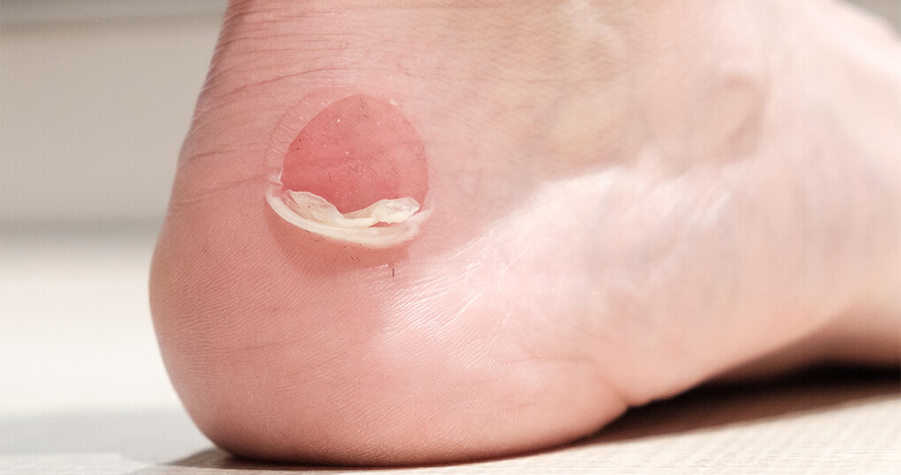 Een blaar verzorgen: Openprikken of niet?