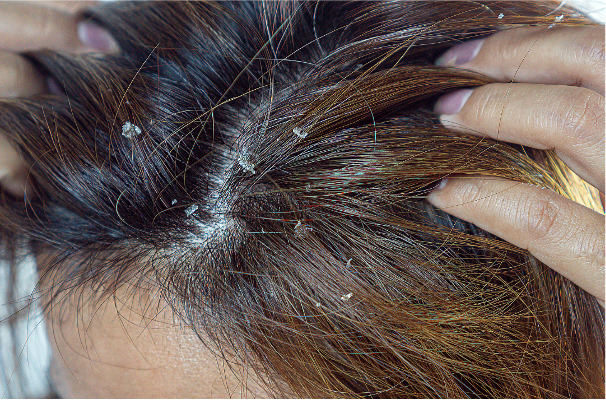 Veel voorkomende hoofdhuidproblemen: dit zijn de oorzaken en zo kom je ervan af   Veel voorkomende hoofdhuidproblemen: dit zijn de oorzaken en zo kom je ervan af