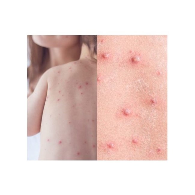 donttellmum - Waterpokken behandeling - 50ml