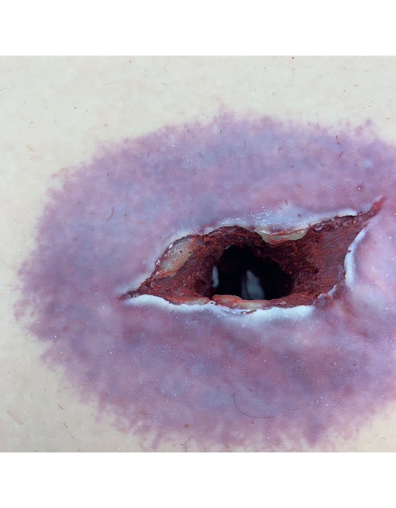 Shrapnelwound in a box LS Medical