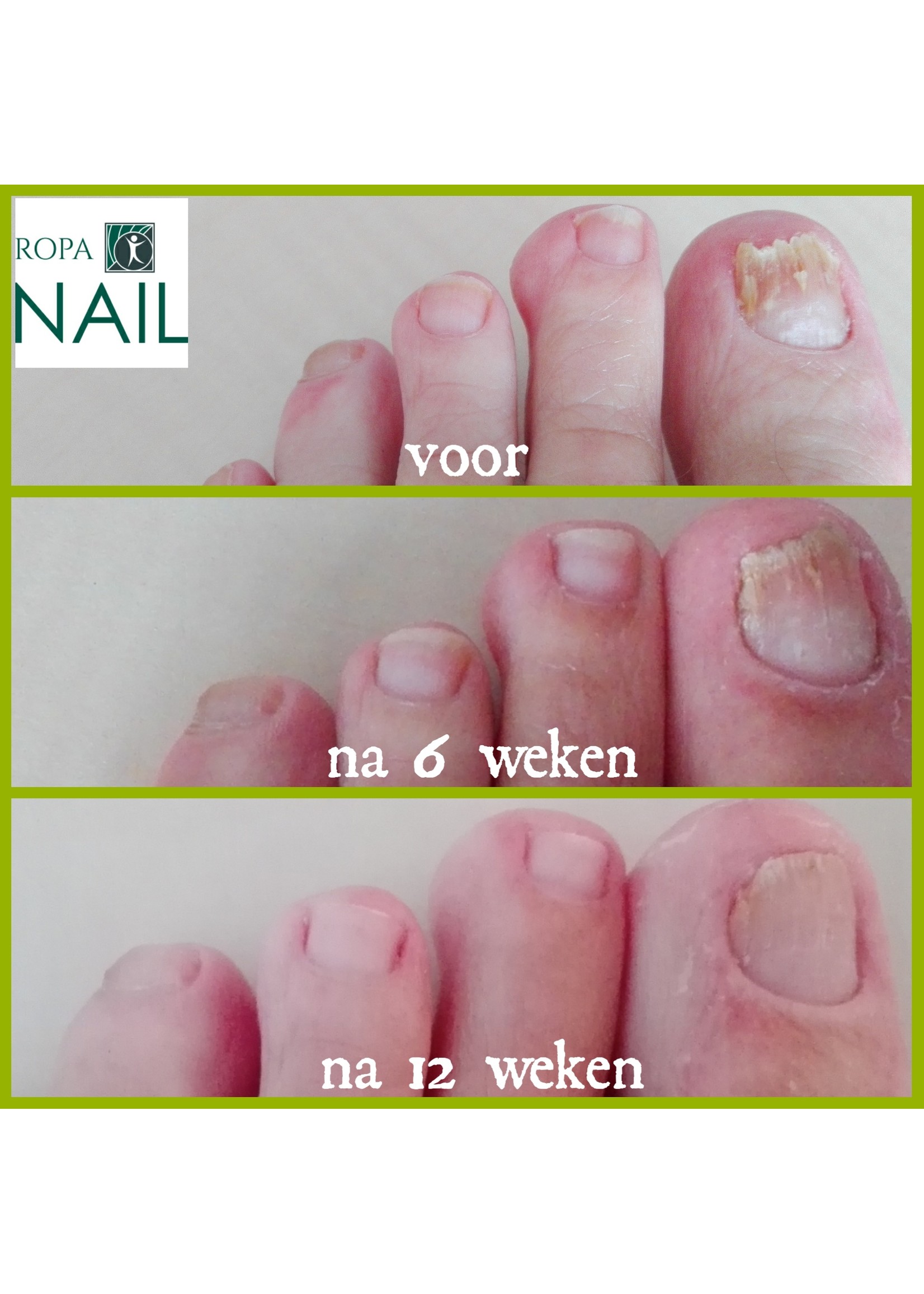 RopaNail 100% natürliche Pflege der Nagelpilz