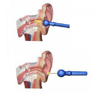 EarScratcher Earwax Remover - Cerumen pen - blue