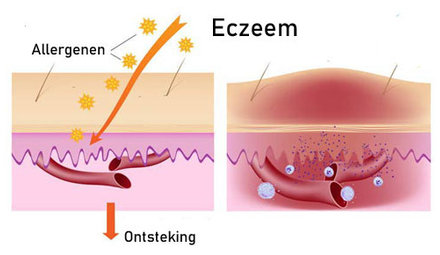 Behandeladvies eczeem