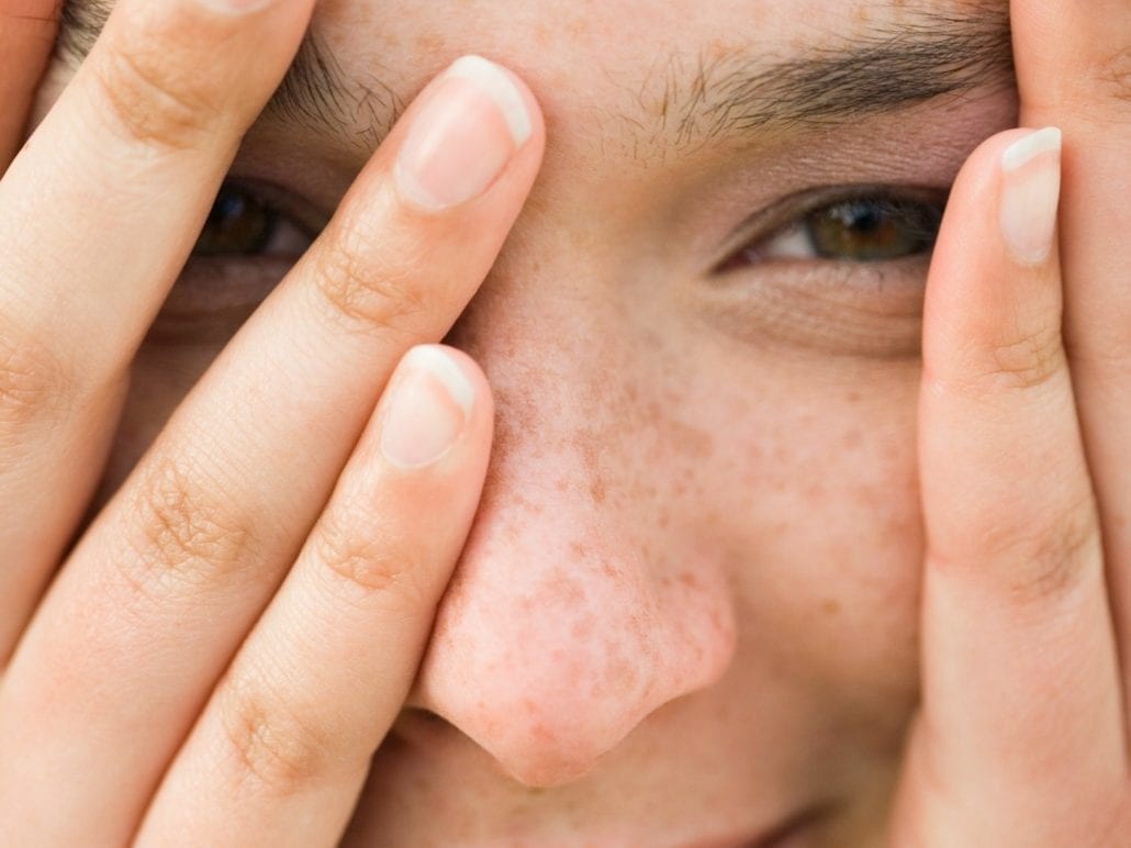 Hoe u Psoriasis Kunt Overwinnen: Een Gids voor Chronische Beheersing