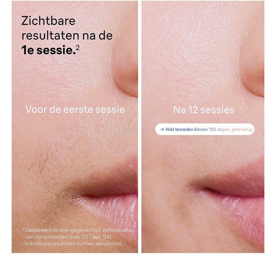 BRAUN Smart IPL7147 IPL-apparaat Wit