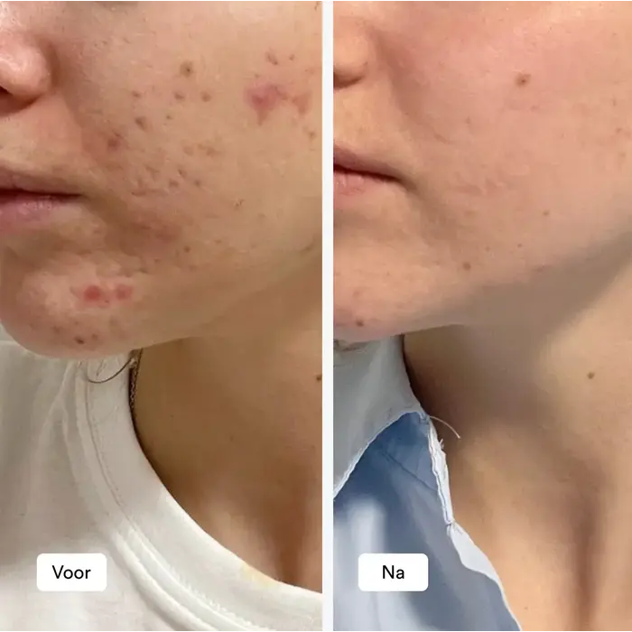 RAY RAY ACNE ROUTINE -15%