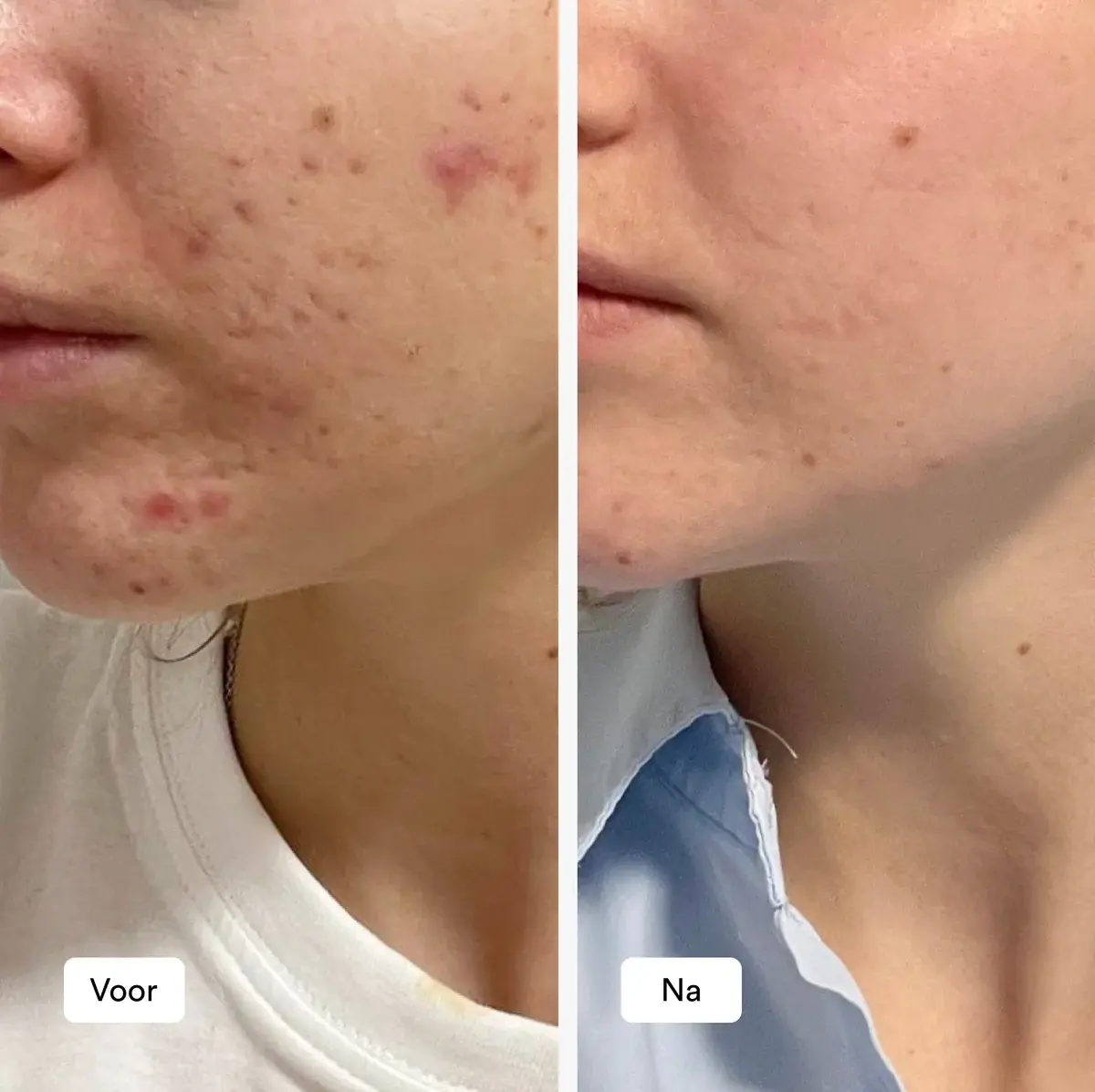 RAY RAY ACNE ROUTINE -15%