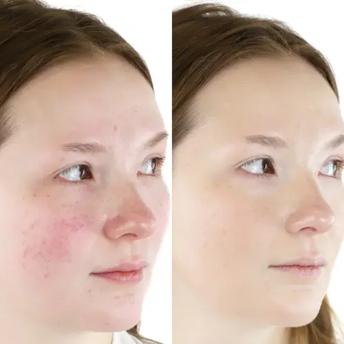 Mineralogie CLEAR Acne Liquid Zinc Foundation - Golden Sand