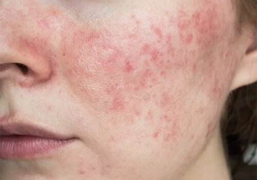 Rosacea