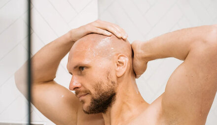 Calvitie et chute de cheveux masculine
