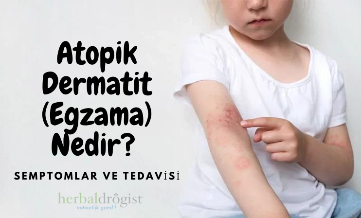  Atopik Dermatit (Egzama) Nedir? Semptomlar ve tedavisi