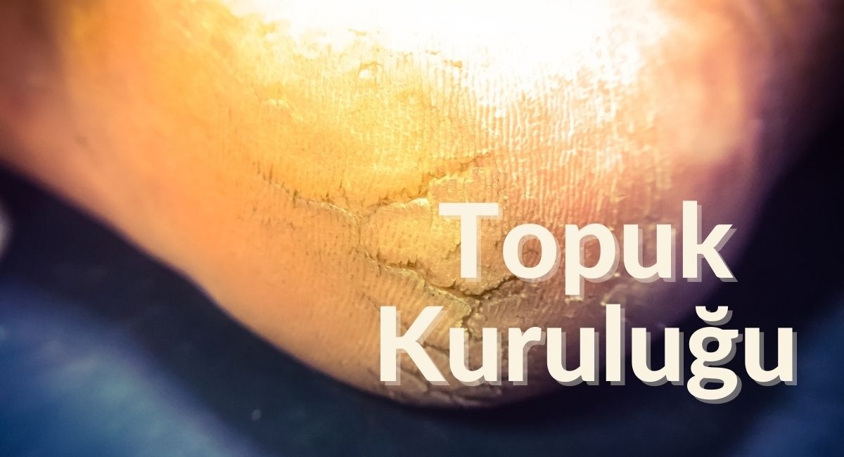 Topuk Kuruluğuna Karşı Etkili Çözümler Ayak Bakımı Önerileri