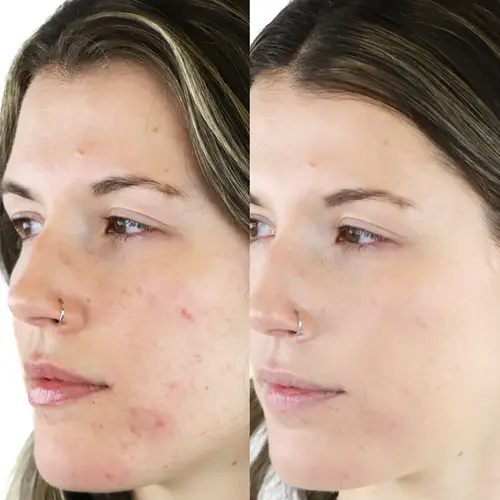 Mineralogie CLEAR Acne Liquid Zinc Foundation - Cool Beige Tester