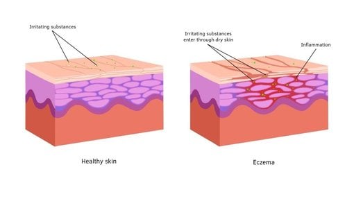 Treatment advice - Eczema