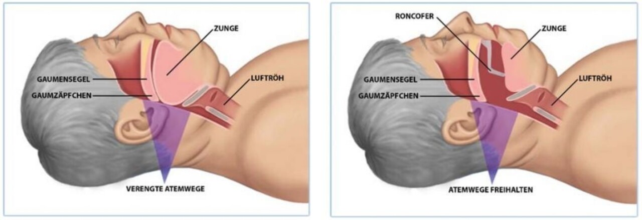 Snurkbeugel Snurkbeugel