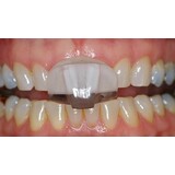 NTI-TSS Knarsbitje - Splint