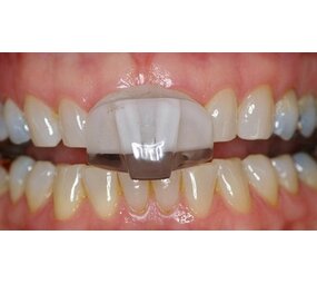 NTI-TSS Knarsbitje - Splint NTI-TSS Knarsbitje - Splint