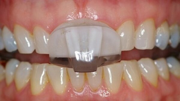 NTI-TSS Knarsbitje - Splint